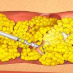 เทคนิค Fat Stem Cell