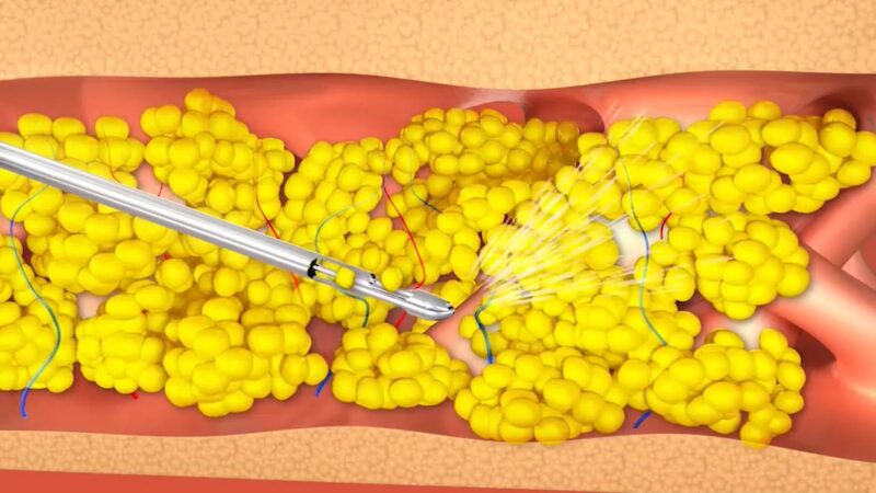 เทคนิค Fat Stem Cell