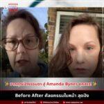 Before After ศัลยกรรมใบหน้า สุดปัง