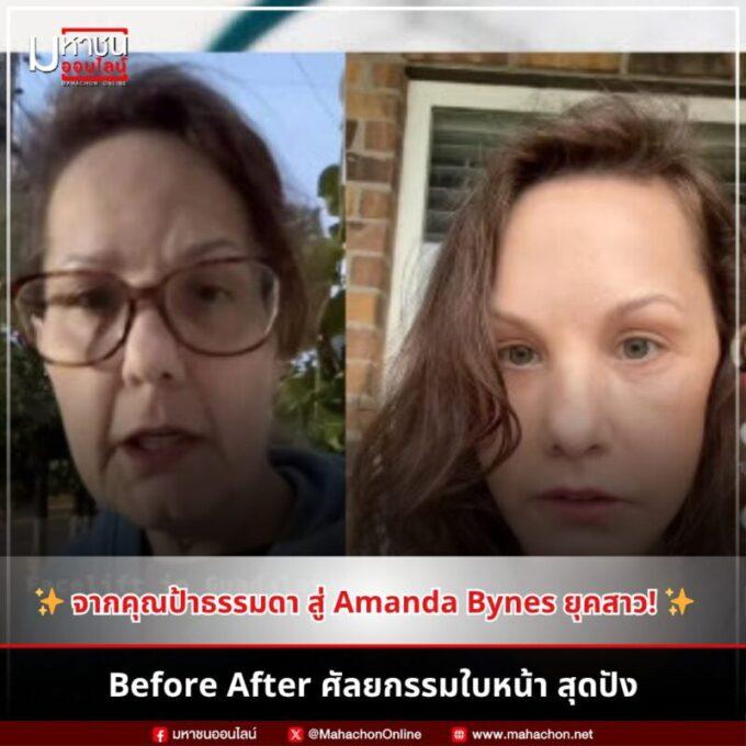 Before After ศัลยกรรมใบหน้า สุดปัง